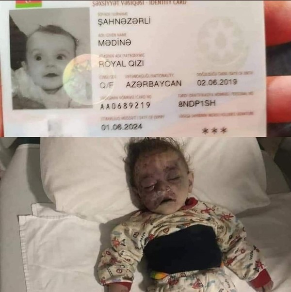 A little child who died after suffering severe wounds.