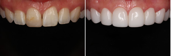 Decayed tooth - resin discoloration, decayed tooth